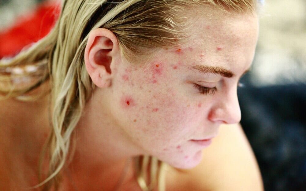 Top Ingredients For Acne-Prone Skin: Expert Tips For Clear Skin 2 Top Ingredients for Acne-Prone Skin: Expert Tips for Clear Skin